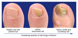 Fungal Nail Infection stages