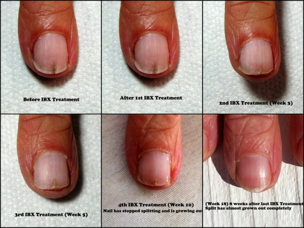 Is ibx nail treatment safe